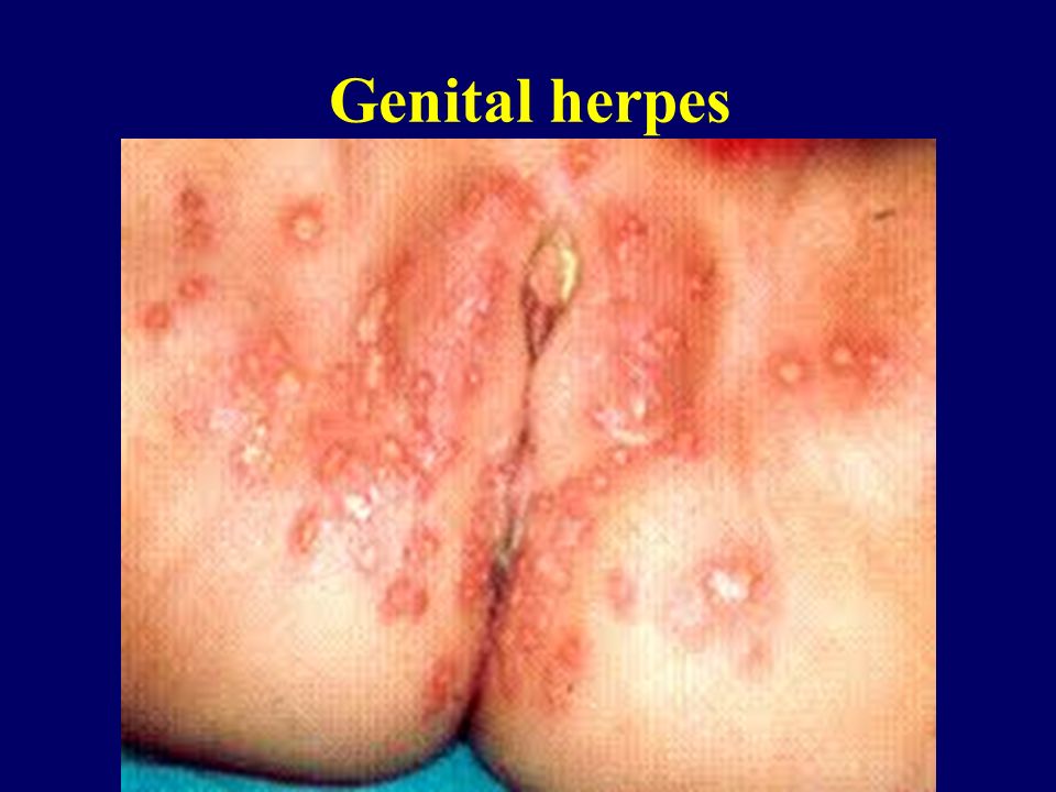 Vagina Herpes Picture Excelent Porn