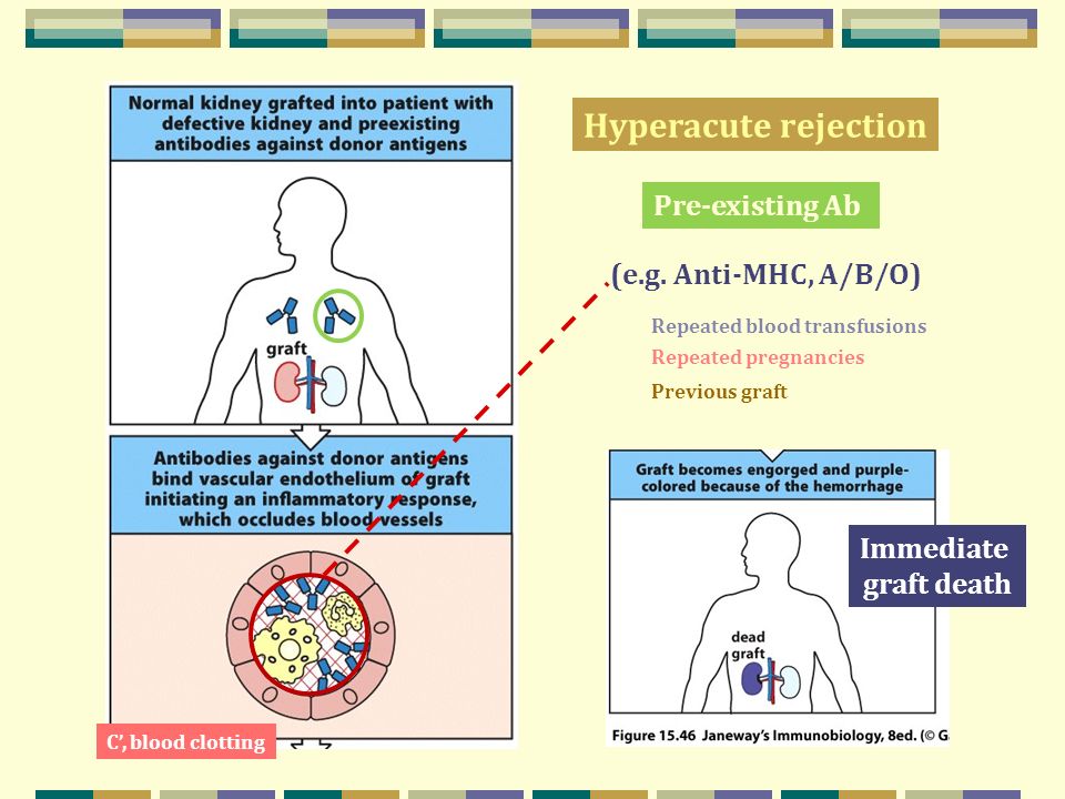 transplant rejection,hairtransplant responses to alloantigens and transplant rejection