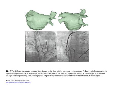 Fig. 5. The different transseptal puncture sites depend on the right inferior pulmonary vein anatomy. A shows typical anatomy of the right inferior pulmonary.