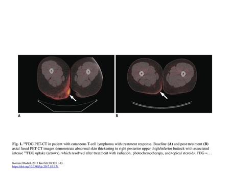 Fig. 1. 18FDG PET-CT in patient with cutaneous T-cell lymphoma with treatment response. Baseline (A) and post treatment (B) axial fused PET-CT images demonstrate.