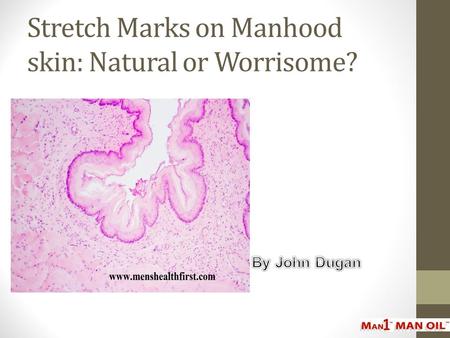 Stretch Marks on Manhood skin: Natural or Worrisome?