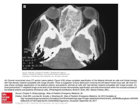 (A) Coronal noncontrast sinus CT section (same patient; Figure 9