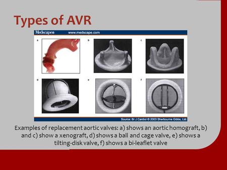 Types of AVR Examples of replacement aortic valves: a) shows an aortic homograft, b) and c) show a xenograft, d) shows a ball and cage valve, e) shows.