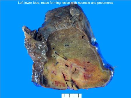 Left lower lobe, mass forming lesion with necrosis and pneumonia.
