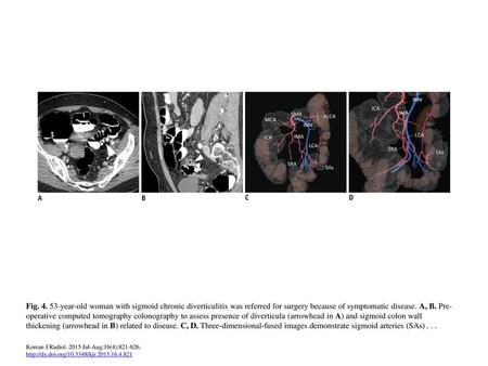 Fig. 4. 53-year-old woman with sigmoid chronic diverticulitis was referred for surgery because of symptomatic disease. A, B. Pre-operative computed tomography.