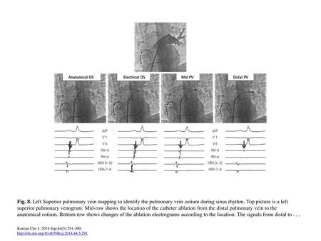 Fig. 8. Left Superior pulmonary vein mapping to identify the pulmonary vein ostium during sinus rhythm. Top picture is a left superior pulmonary venogram.