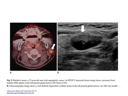Fig. 9. Warthin's tumor, a 72-year-old man with supraglottic cancer. A
