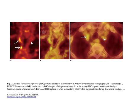Fig. 2. Arterial fluorodeoxyglucose (FDG) uptake related to atherosclerosis. On positron emission tomography (PET) coronal (A), PET/CT fusion coronal (B),