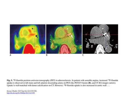 Fig F-fluoride positron emission tomography (PET) in atherosclerosis