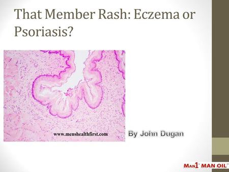 That Member Rash: Eczema or Psoriasis?