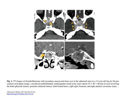 Fig. 1. CT images of chondroblastoma with secondary aneurysmal bone cyst in the sphenoid sinus in a 13-year-old boy.A. On pre-contrast axial plane image,