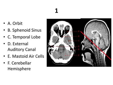 1 A. Orbit B. Sphenoid Sinus C. Temporal Lobe