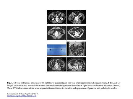 Fig. 1. 62-year-old female presented with right lower quadrant pain one year after laparoscopic cholecystectomy.A-D.Axial CT images show localized omental.