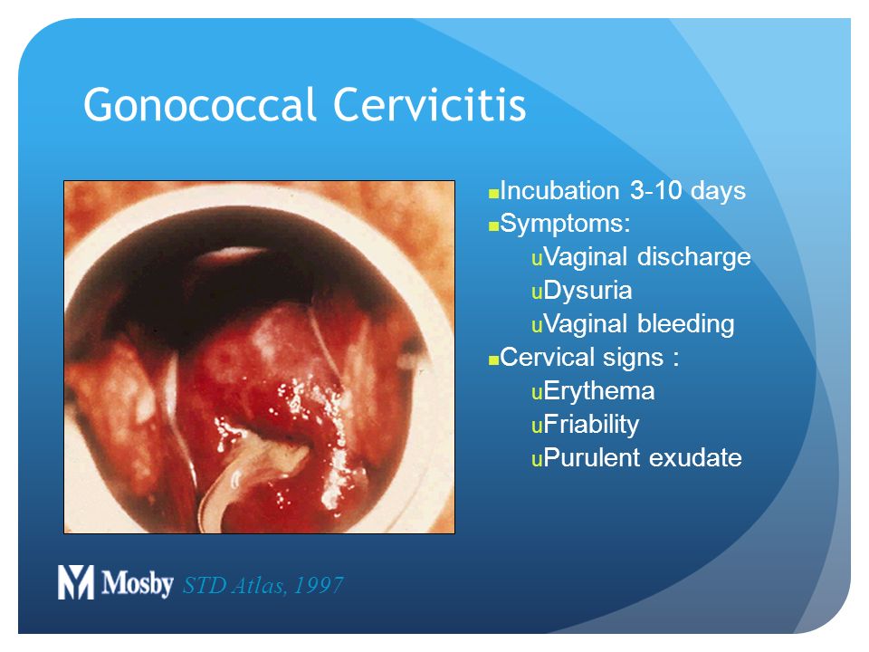 Vaginal,vaginalis year gonococcal cervicitis incubation 3-10 dayssymptoms:vaginal