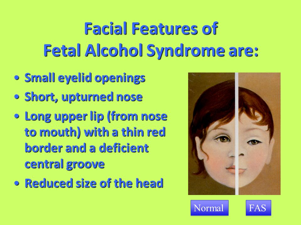 Best of Fetal alcohol syndrome and facial characteristics Train anal orgasm for guys
