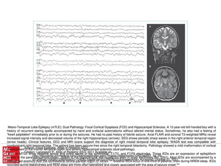 Automatisms with preserved responsiveness were observed exclusively during seizures arising from the right nondominant temporal lobe. They were not observed.