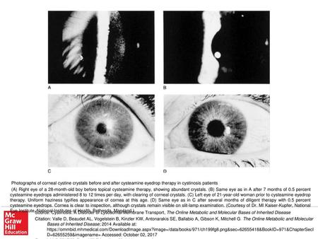 (A) Right eye of a 28-month-old boy before topical cysteamine therapy, showing abundant crystals. (B) Same eye as in A after 7 months of 0.5 percent cysteamine.