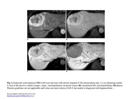 Fig. 3. Gadoxetic acid-enhanced MRI in 69-year-old man with chronic hepatitis C.On arterial phase (A), 1.2 cm enhancing nodule is seen in S8 (arrows),