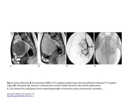 Fig. 2. Uterine fibroid.A, B. Pre-procedural MRI on T2-weighted sagittal image (A) and gadolinium enhanced T1-weighted image (B). Intramutal type myoma.