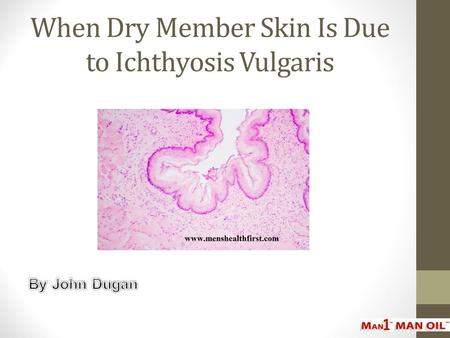 When Dry Member Skin Is Due to Ichthyosis Vulgaris