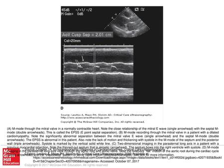 (A) M-mode through the mitral valve in a normally contractile heart