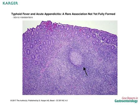 Typhoid Fever and Acute Appendicitis: A Rare Association Not Yet Fully Formed - DOI:10.1159/000479310 Fig. 1. H&E staining postlaparoscopic appendectomy.