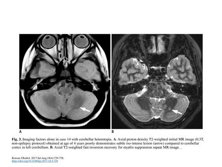 Fig. 3. Imaging factors alone in case 14 with cerebellar heterotopia. A. Axial proton density T2-weighted initial MR image (0.3T, non-epilepsy protocol)