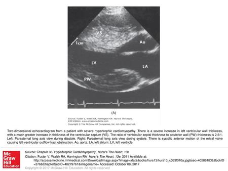 Two-dimensional echocardiogram from a patient with severe hypertrophic cardiomyopathy. There is a severe increase in left ventricular wall thickness, with.