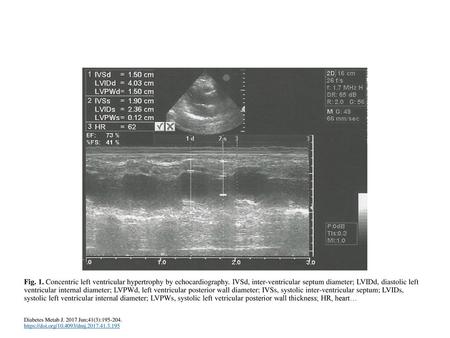 Fig. 1. Concentric left ventricular hypertrophy by echocardiography