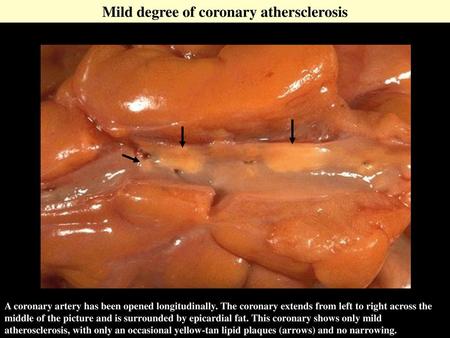 Mild degree of coronary athersclerosis