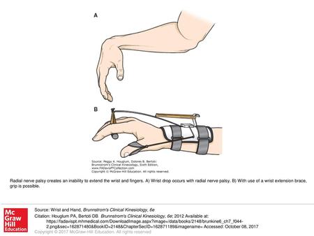 Radial nerve palsy creates an inability to extend the wrist and fingers. A) Wrist drop occurs with radial nerve palsy. B) With use of a wrist extension.