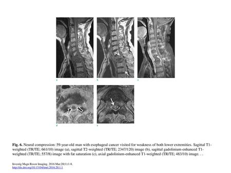 Fig. 6. Neural compression: 59-year-old man with esophageal cancer visited for weakness of both lower extremities. Sagittal T1-weighted (TR/TE; 661/10)