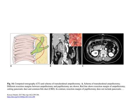 Fig. 14. Computed tomography (CT) and schema of transduodenal ampullectomy. A. Schema of transduodenal ampullectomy. Different resection margins between.