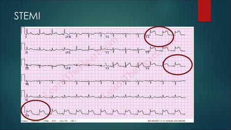 STEMI.