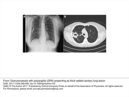 Figure 1 (A) Chest x-ray (posteroanterior view) showed a cavitary lesion with an air-fluid level in the right upper lobe. (B) Computed tomography of the.