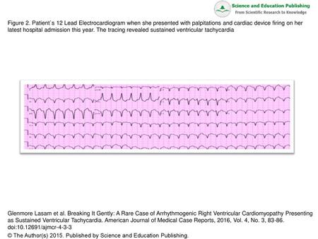 Figure 2. Patient`s 12 Lead Electrocardiogram when she presented with palpitations and cardiac device firing on her latest hospital admission this year.