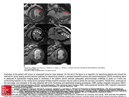 E. Stress and rest myocardial perfusion PET images obtained with rubidium-82 in a patient with chest pain on exertion. The images demonstrate a large and.