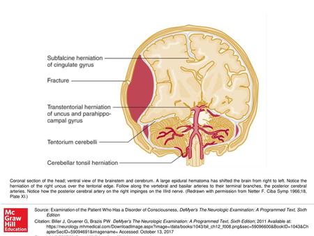 Coronal section of the head; ventral view of the brainstem and cerebrum. A large epidural hematoma has shifted the brain from right to left. Notice the.