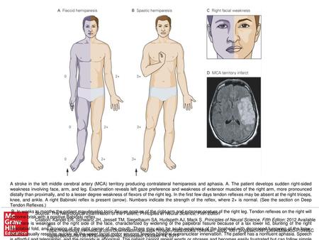 D. Site of stroke is on the left parieto-frontal region