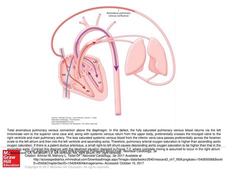 Total anomalous pulmonary venous connection above the diaphragm