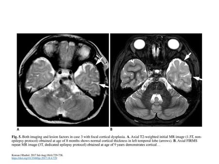 Fig. 5. Both imaging and lesion factors in case 3 with focal cortical dysplasia. A. Axial T2-weighted initial MR image (1.5T, non-epilepsy protocol) obtained.