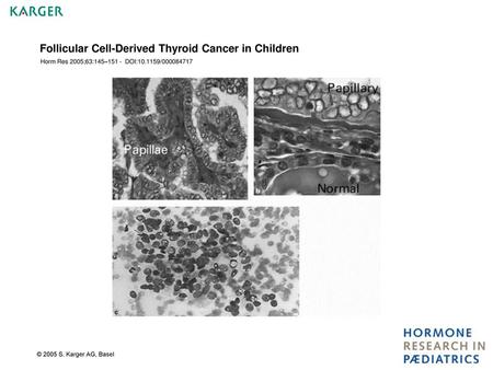 Follicular Cell-Derived Thyroid Cancer in Children