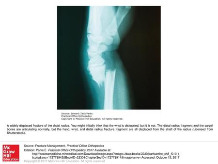 A widely displaced fracture of the distal radius