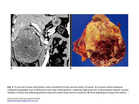 Fig. 1. 53-year-old woman with primary renal extraskeletal Ewing sarcoma family of tumors. A. Coronal contrast-enhanced computed tomography scan of abdomen.