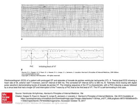 Electrocardiogram (ECG) of a patient with prolonged QT and episodes of torsade de pointes ventricular tachycardia (VT). A. Twelve-lead ECG showing a heart.