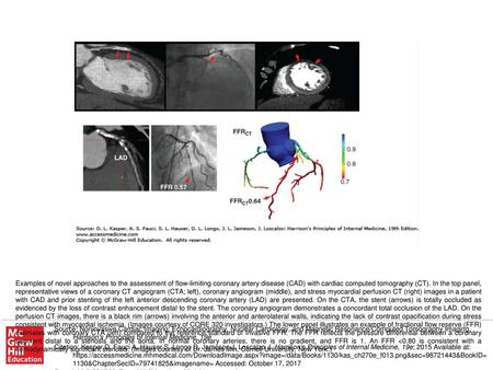 Examples of novel approaches to the assessment of flow-limiting coronary artery disease (CAD) with cardiac computed tomography (CT). In the top panel,