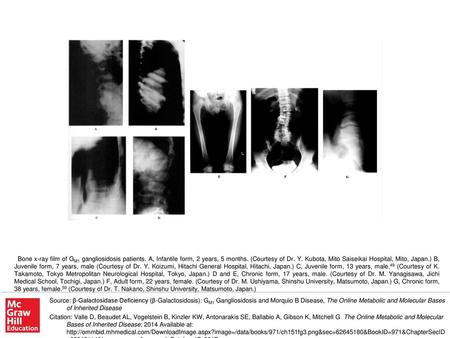 Bone x-ray film of GM1 gangliosidosis patients