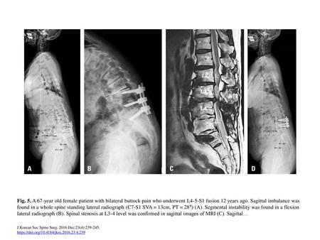 Fig. 5. A 67-year old female patient with bilateral buttock pain who underwent L4-5-S1 fusion 12 years ago. Sagittal imbalance was found in a whole spine.