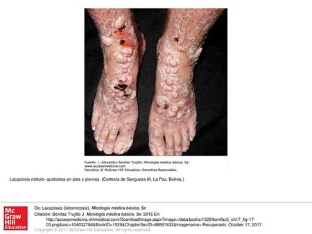 Lacaziosis nódulo- queloidea en pies y piernas
