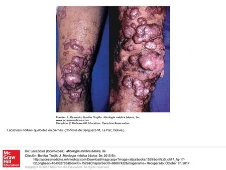 Lacaziosis nódulo- queloidea en piernas